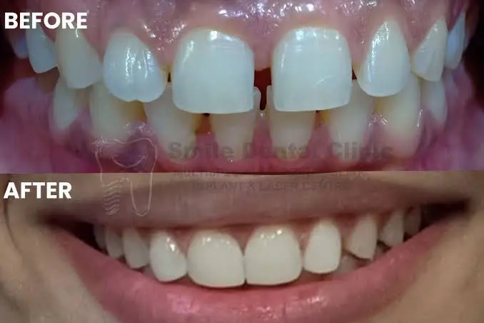Smile Designing
